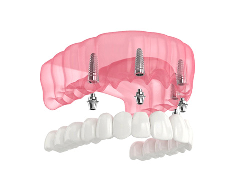 Render of All-on-4 implants in Ledgewood, NJ for upper arch