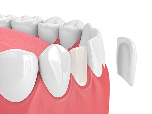 3D render of a covered tooth