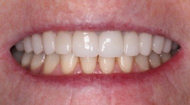 Bright smile after teeth whitening