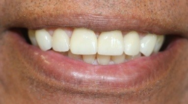 Flawless smile after cosmetic dentistry