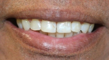 Discolored smile before cosmetic dentistry