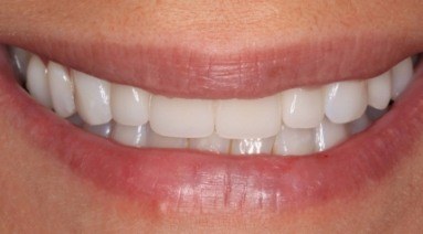 Brilliant smile after professional teeth whitening