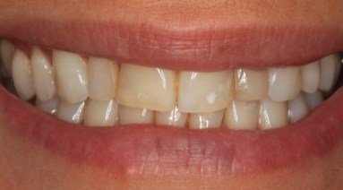 Yellowed smile before professional teeth whitening