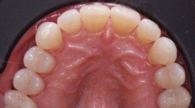Straightened teeth after orthodontic treatment