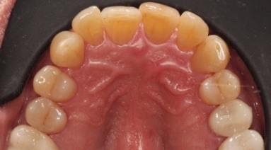 Crooked teeth prior to orthodontic treatment