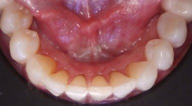 Straightened bottom teeth after orthodontic treatment