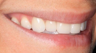 Close up of smile after top tooth is repaired