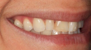 Close up of smile with damaged top tooth
