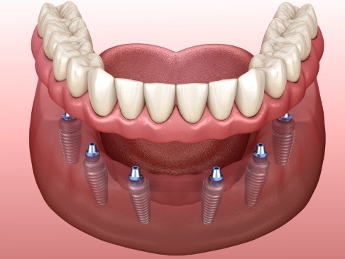 Animated smile during full mouth reconstruction using dental implant supported denture
