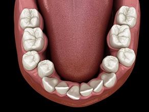 Illustration of crowed teeth