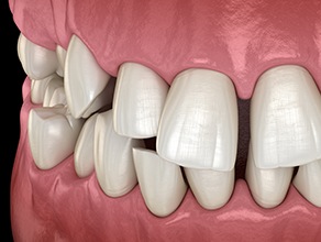 Illustration of gapped teeth