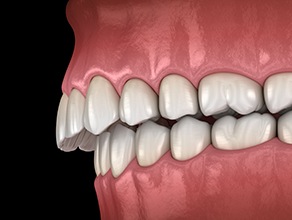 Illustration of a crossbite