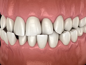 Illustration of a crossbite