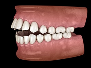 Illustration of an open bite