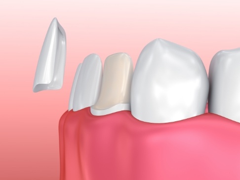 Animated smile during porcelain veneer placement