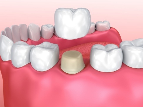 Animated smile during metal free dental crown restoration