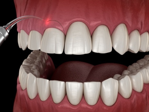 Animated smile during gum recontouring treatment