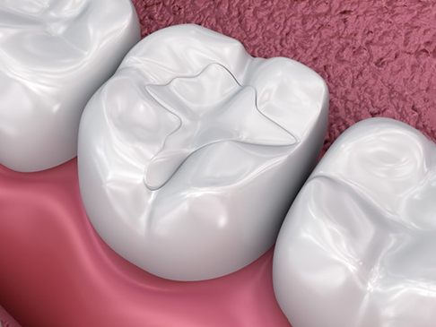 a 3 D illustration of tooth colored fillings