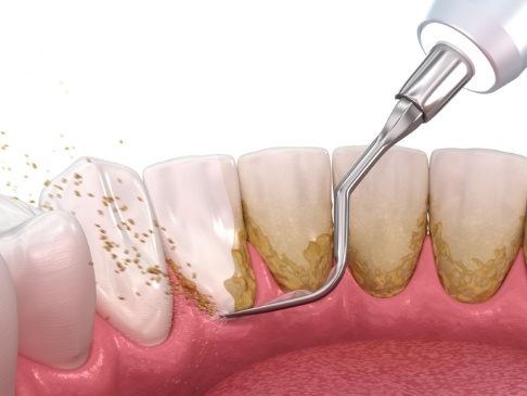 Animated smile during periodontal therapy