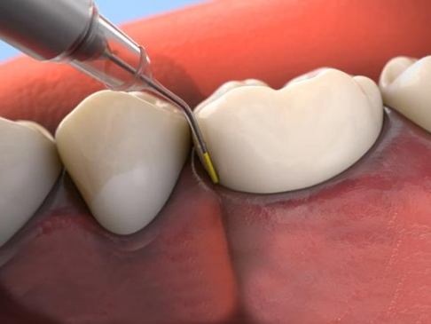 Animated smile during Arestin antibiotic therapy