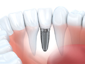 Render of single dental implant in Ledgewood, NJ for lower arch