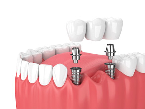 Render of dental bridge supported by dental implants in Ledgewood, NJ