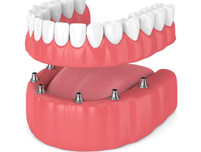 Illustration of dentures and dental implants in Ledgewood, NJ