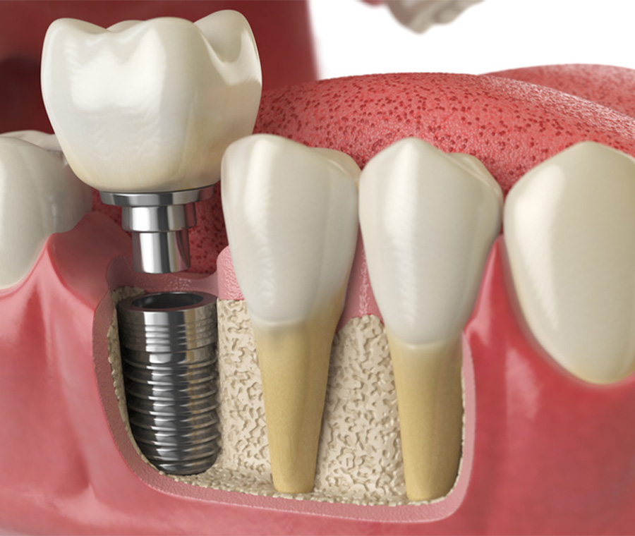 Animated smile with dental implant post implanted in jaw line