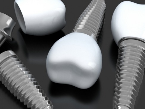 Three animated dental implant supported replacement teeth