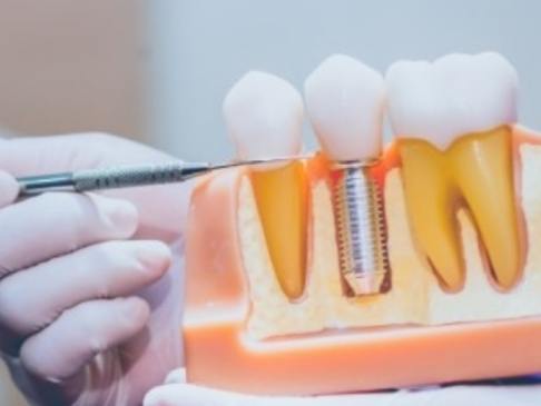 Model comparing natural teeth to dental implant supported replacement tooth