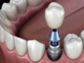 Animated smile during dental implant supported dental crown placement