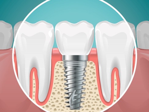 A 3D illustration of a placed dental implant