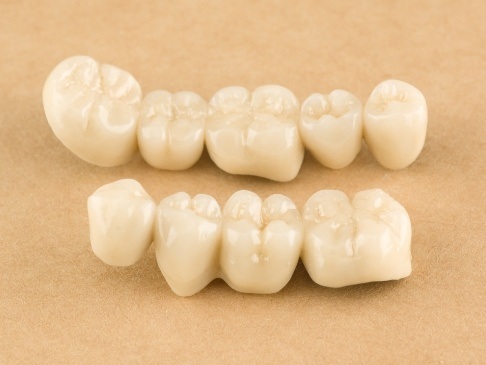 Dental bridges prior to placement