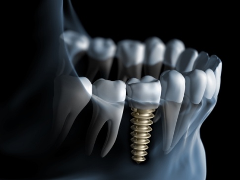 Animated smile with dental implant supported replacement tooth