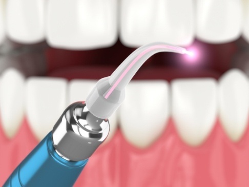 Animated smile during soft tissue laser dentistry