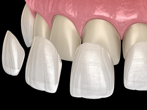 3D illustration of veneers being placed 