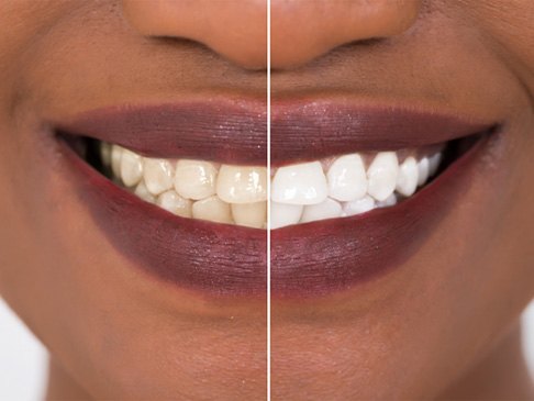 Smile before and after teeth whitening treatment