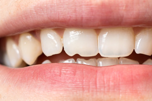 Close-up of smile with a chipped tooth